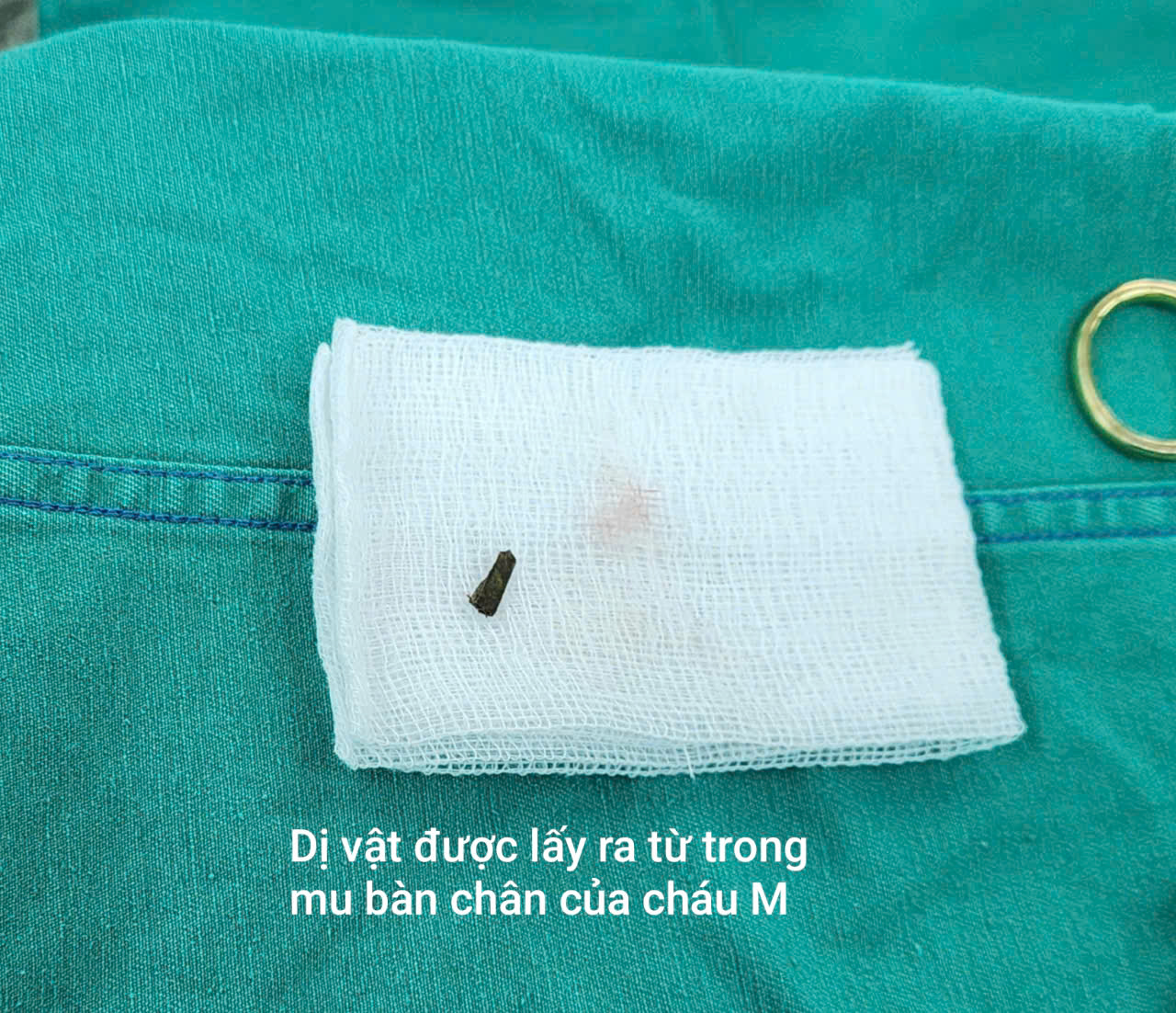 Cứu bé gái 7 tuổi chơi bóng đá bị gỗ mục đâm vào chân dẫn đến mắc uốn ván- Ảnh 3.