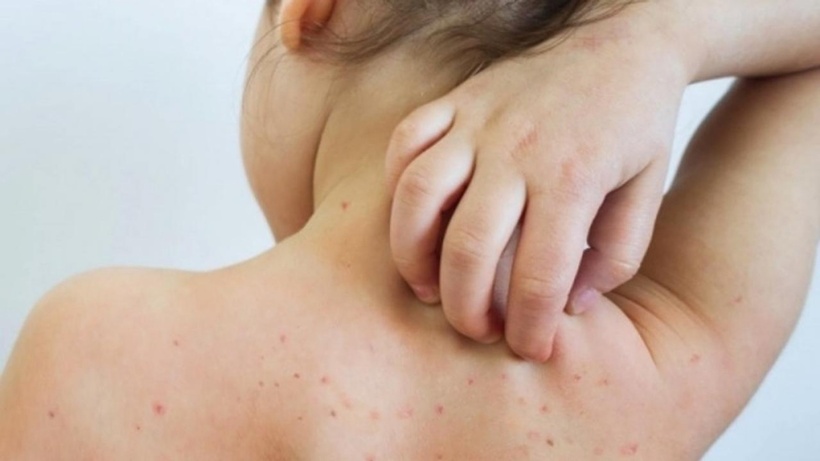 Một ca rubella vừa phát hiện: Bố mẹ chủ quan, trẻ lãnh hậu quả- Ảnh 1. Một ca rubella vừa phát hiện: Bố mẹ chủ quan, trẻ lãnh hậu quả- Ảnh 1.
