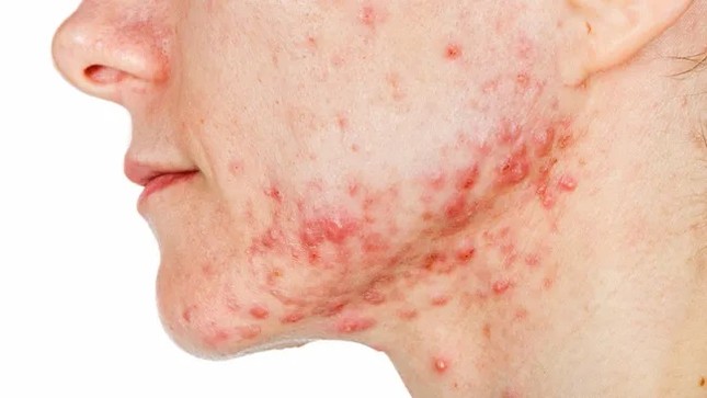 Sắp có vắc xin ngừa mụn trứng cá- Ảnh 1.