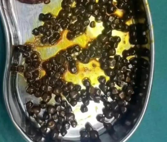 Bé gái 10 tuổi thường xuyên bỏ bữa sáng, đi khám bố mẹ "sốc nặng" khi bác sĩ lấy ra thứ này- Ảnh 1.