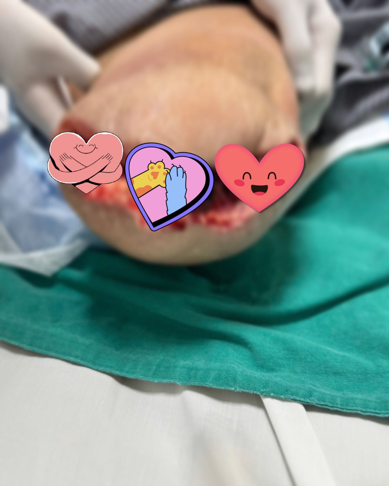 Giành giật sự sống từng giờ cho bệnh nhân ban đầu chỉ bị vết bỏng nhỏ ở chân: Ai mắc bệnh này hãy chăm sóc bàn chân thật cẩn thận!- Ảnh 1.