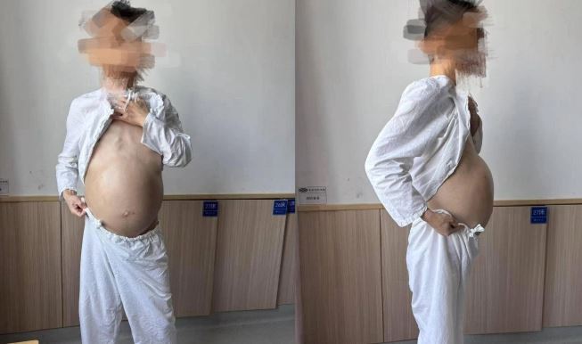 Người đàn ông 40 tuổi bụng to như mang bầu, khi phẫu thuật bác sĩ phát hiện điều đáng sợ- Ảnh 1.