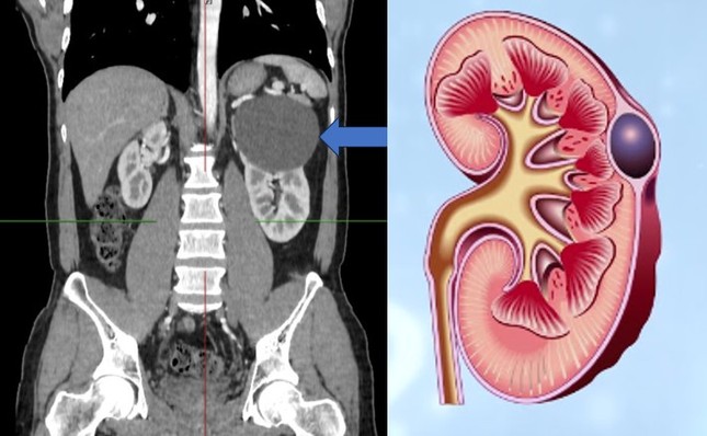 Bác sĩ chuyên khoa nói về căn bệnh 'cực kỳ phiền toái', đàn ông mắc nhiều gấp đôi phụ nữ- Ảnh 2.
