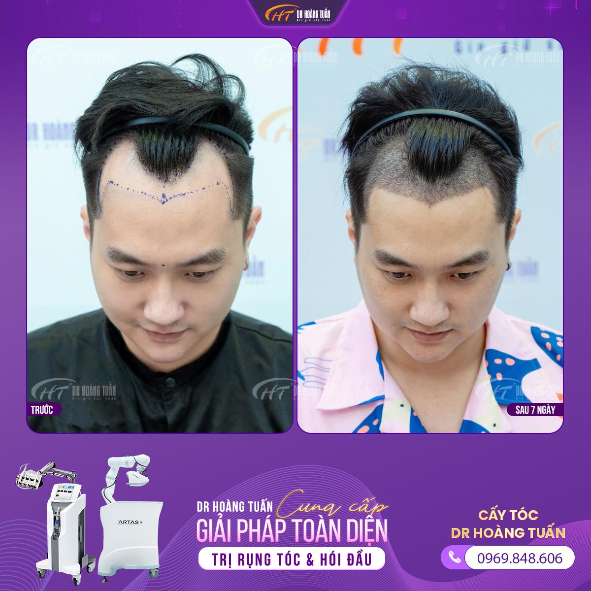 Diễn viên “Phố trong làng” đi cấy tóc: Ngủ một giấc tỉnh dậy, trán hói chữ M “bay màu”, trẻ ra vài tuổi- Ảnh 4.