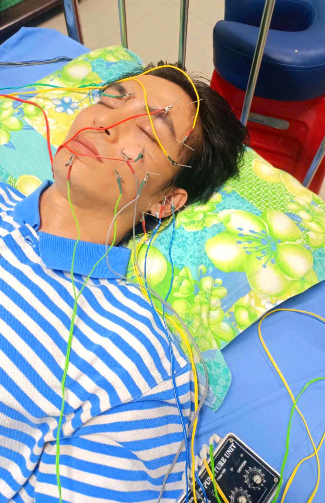 Nam thần màn ảnh Việt bị liệt dây thần kinh số 7, hình ảnh châm cứu gây lo lắng- Ảnh 1.