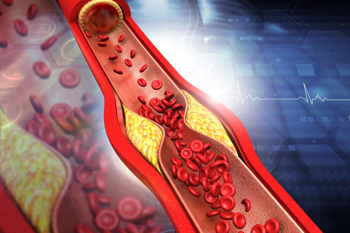 1 triệu chứng xảy ra trên giường có thể báo hiệu động mạch tắc nghẽn, cholesterol cao ngất ngưởng- Ảnh 1.