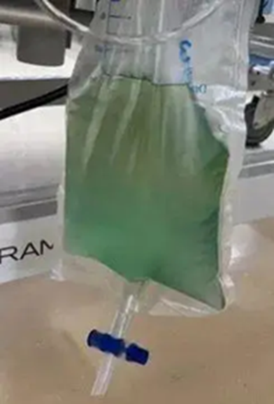Nam thanh niên 25 tuổi tiểu ra "nước xanh kỳ quái”, hôn mê sâu vì trúng kịch độc thường thấy trong món ăn nhiều người Việt mê- Ảnh 1.