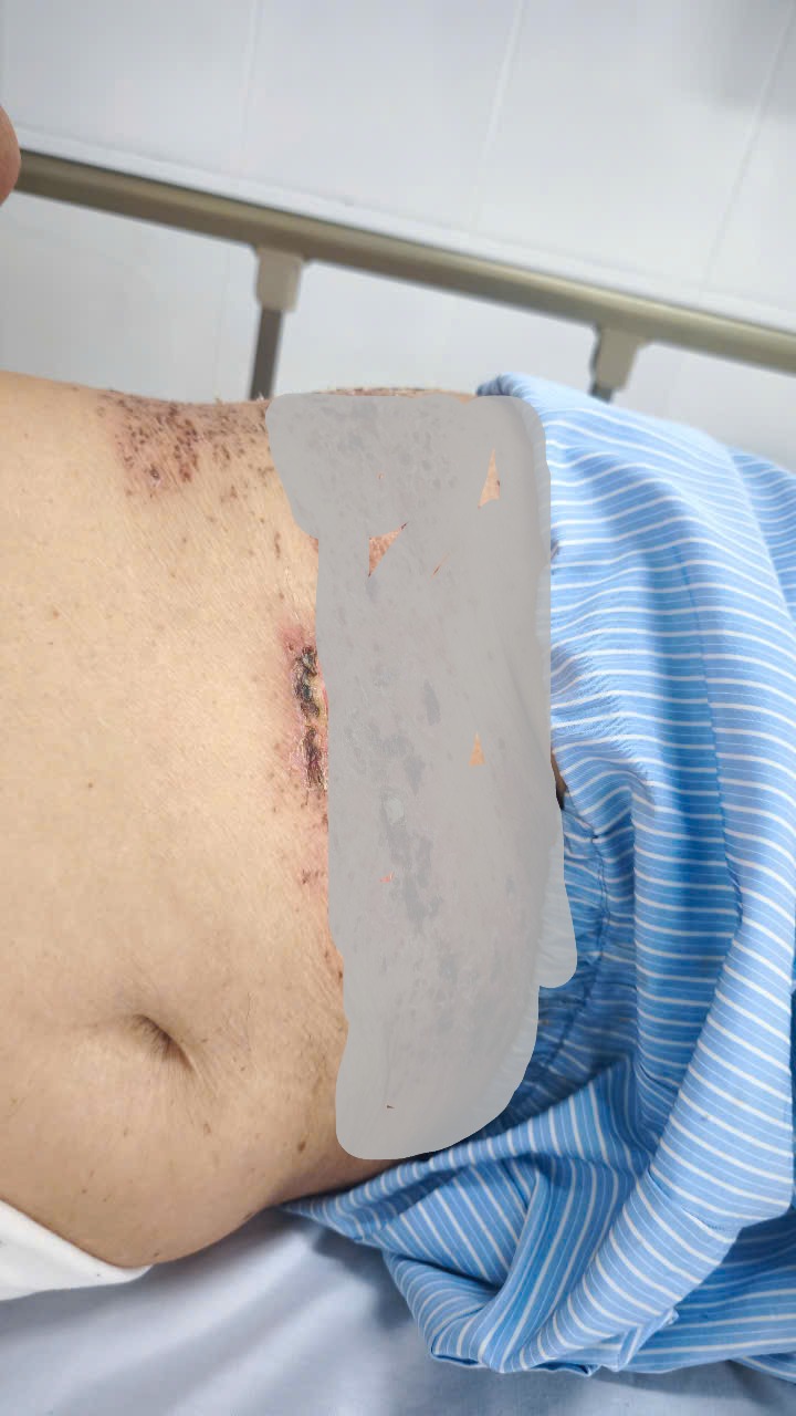 Tưởng mình bị bệnh "giời leo" nên áp dụng mẹo dân gian, bệnh nhân bị biến chứng nặng- Ảnh 2.