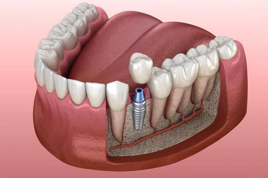 Tiêu chân răng là gì? Phân loại và cách điều trị- Ảnh 3.