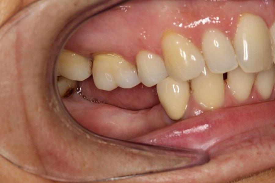 Tiêu chân răng là gì? Phân loại và cách điều trị- Ảnh 1.