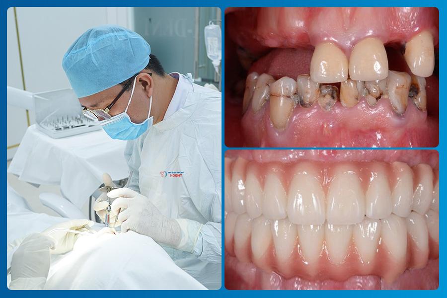 Tiêu chân răng là gì? Phân loại và cách điều trị- Ảnh 4.