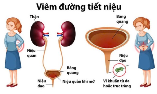 Những dấu hiệu cảnh báo của cơ thể dễ bị chị em bỏ qua nhưng 'phá thận' nhanh khủng khiếp- Ảnh 2.