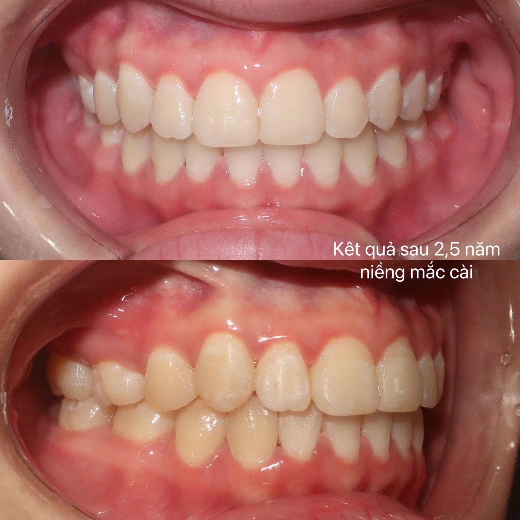 Niềng răng sau tuổi 30: Bác sĩ nói trễ nhưng không hề muộn để đẹp và khỏe- Ảnh 4.