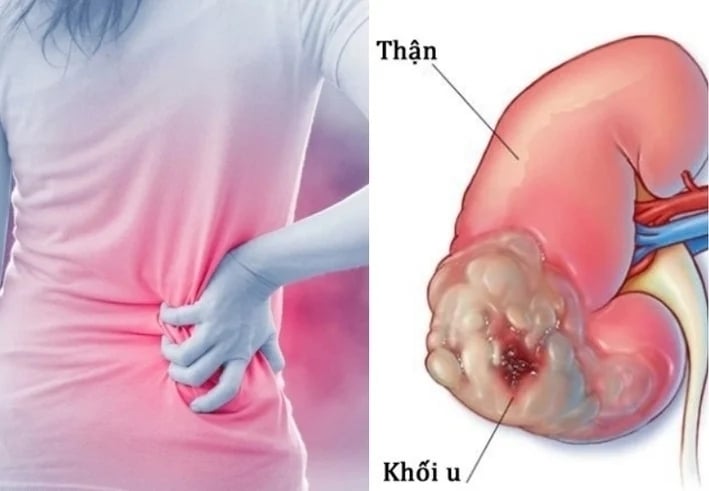 Dấu hiệu thầm lặng cảnh báo ung thư thận- Ảnh 1.