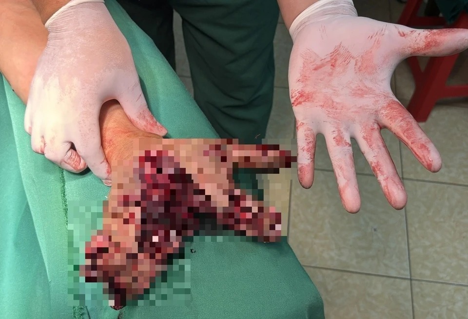 Vừa sạc pin vừa dùng điện thoại, người đàn ông Điện Biên bị chẻ đôi bàn tay- Ảnh 1.
