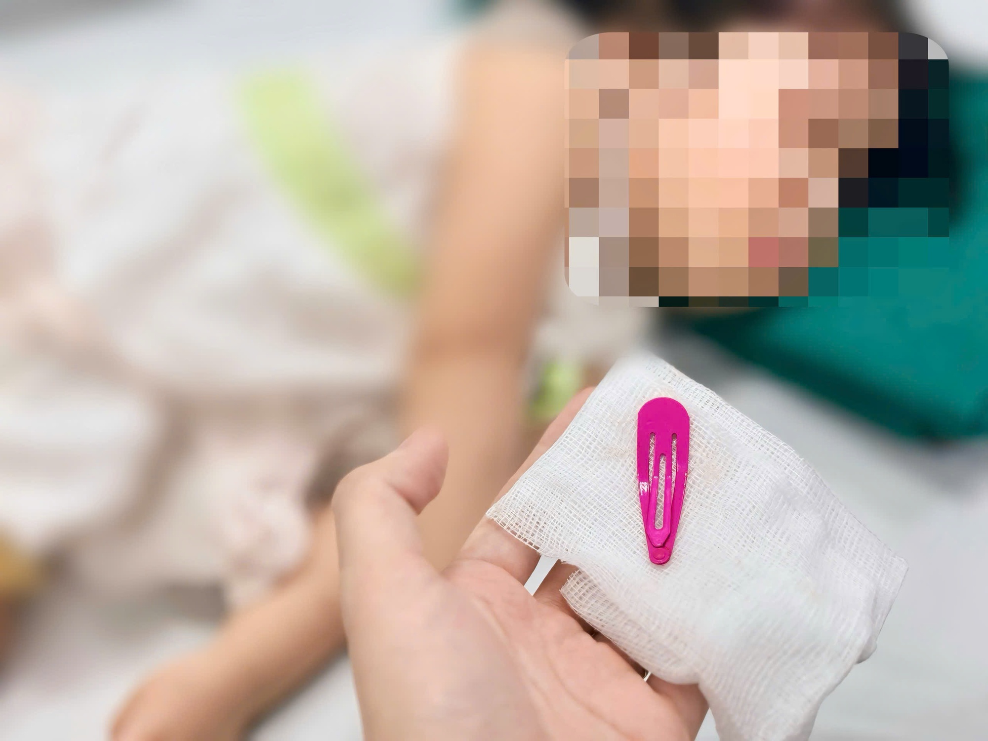 Hà Nội: Bé gái 21 tháng tuổi nhập viện sau khi nuốt một chiếc kẹp tóc kim loại- Ảnh 3.