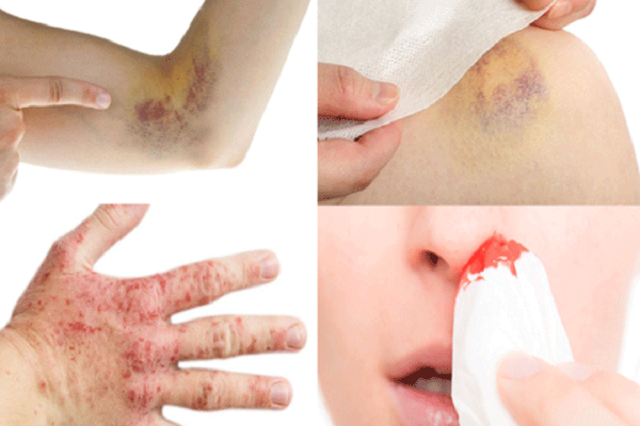 Khoảnh khắc cô gái 23 tuổi bị ung thư máu ngồi khóc ở hành lang bệnh viện khiến nhiều người đau lòng: Đừng bỏ qua những dấu hiệu bệnh- Ảnh 3.