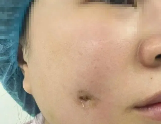 Người phụ nữ bị nhiễm trùng sau khi làm má lúm đồng tiền- Ảnh 1.