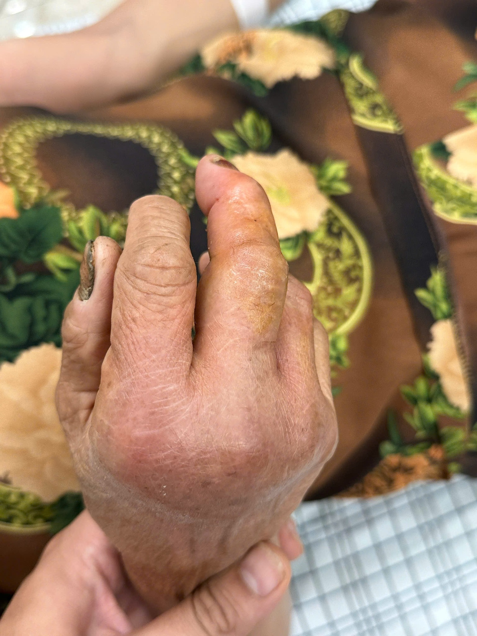 Ra chuồng gà vào buổi tối, người phụ nữ ở Phú Thọ phải đi cấp cứu với bàn tay sưng húp, đau nhức dữ dội- Ảnh 1.