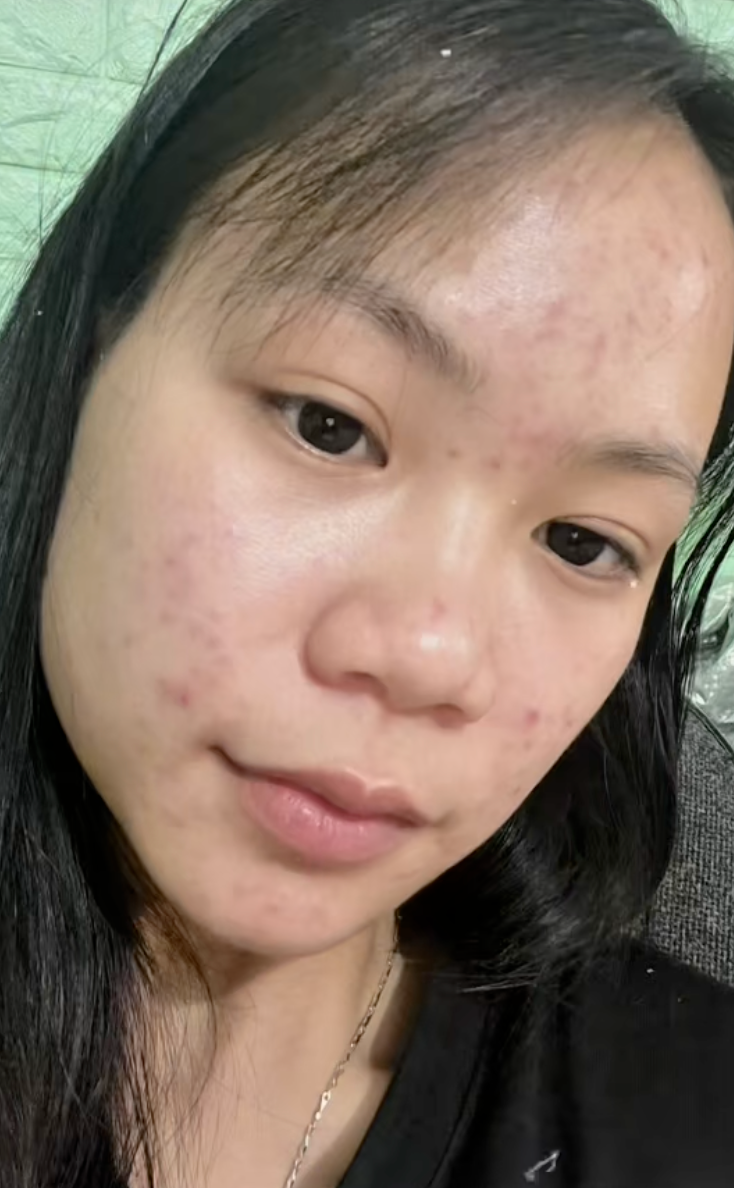 Da chi chít mụn do 5 năm rửa mặt sai cách, cô nàng chữa lành làn da bằng loại hạt mà mọi người vứt bỏ- Ảnh 2.