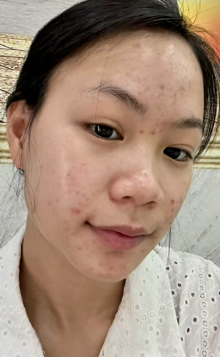 Da chi chít mụn do 5 năm rửa mặt sai cách, cô nàng chữa lành làn da bằng loại hạt mà mọi người vứt bỏ- Ảnh 1.