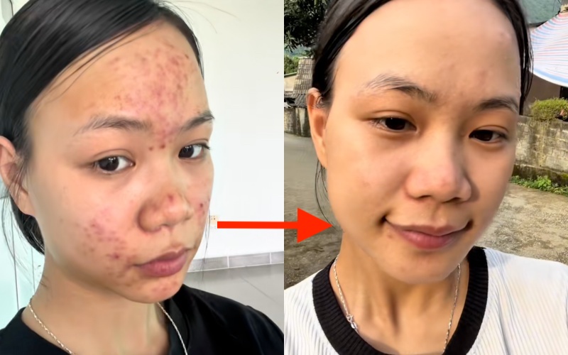 Da chi chít mụn do 5 năm rửa mặt sai cách, cô nàng chữa lành làn da bằng loại hạt mà mọi người vứt bỏ- Ảnh 16.