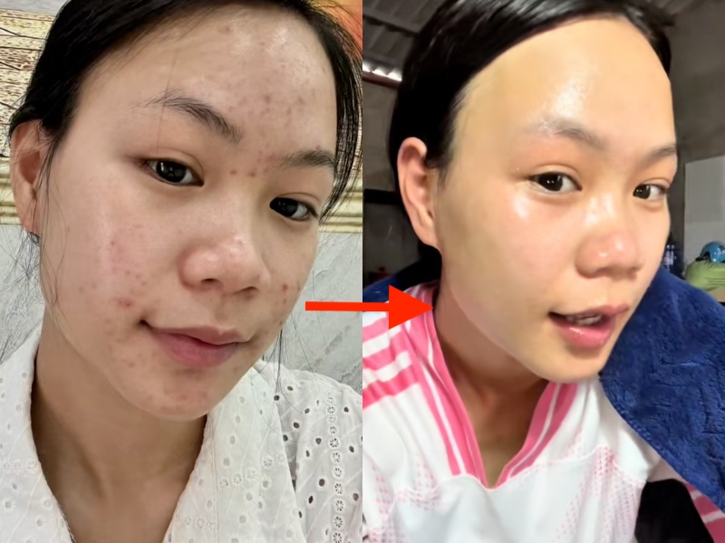Da chi chít mụn do 5 năm rửa mặt sai cách, cô nàng chữa lành làn da bằng loại hạt mà mọi người vứt bỏ- Ảnh 9.