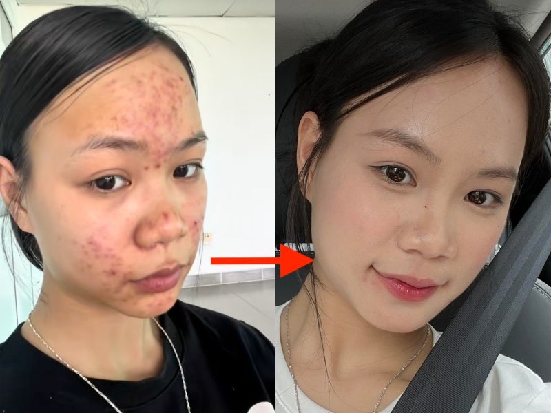 Da chi chít mụn do 5 năm rửa mặt sai cách, cô nàng chữa lành làn da bằng loại hạt mà mọi người vứt bỏ- Ảnh 17.
