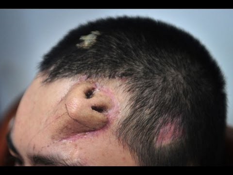 Không phải ảnh lỗi của AI, người đàn ông này đã thực sự mọc một chiếc mũi trên trán: Đó là "tác phẩm" của các bác sĩ Trung Quốc- Ảnh 4.