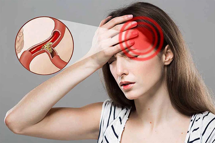Ngày càng nhiều người bị nhồi máu não: Cảnh giác 3 loại gia vị là "thủ phạm", ghi nhớ quy tắc "một nhìn, hai nghe, ba cảm nhận" để phát hiện bệnh- Ảnh 4.