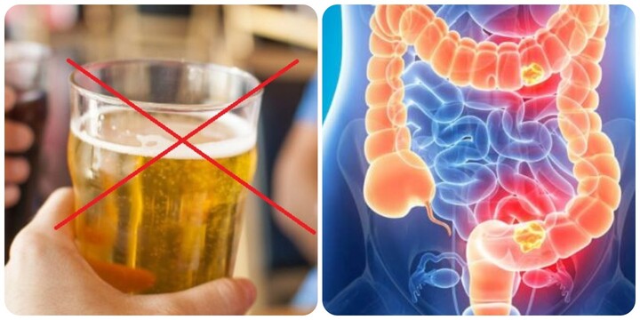 Bác sĩ chỉ cách phòng ngừa ung thư đại trực tràng- Ảnh 1. Bác sĩ chỉ cách phòng ngừa ung thư đại trực tràng- Ảnh 1.