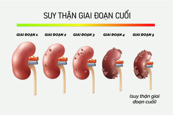 Nữ diễn viên phim "Mai" bị suy thận giai đoạn cuối ở tuổi 29: Phương pháp điều trị là gì?- Ảnh 3.