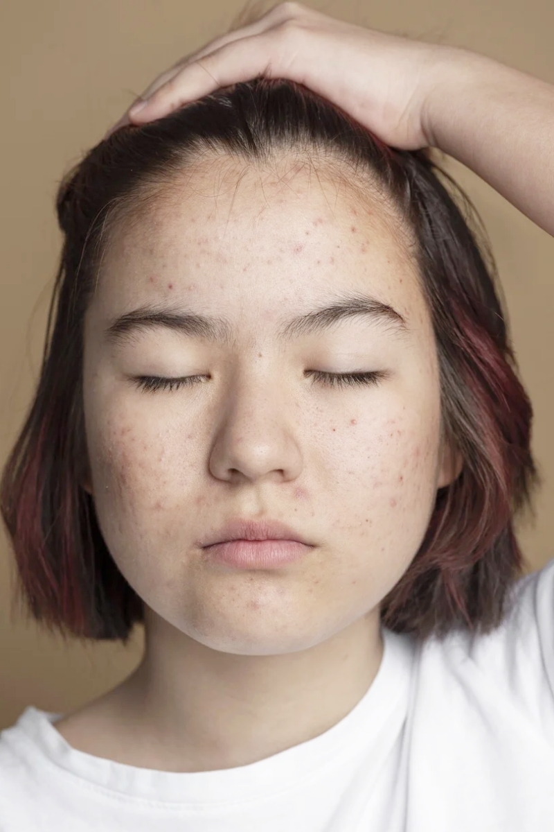 Hướng dẫn dùng Retinol đúng cách, da bị nổi mụn khi dùng có phải là điều bình thường?- Ảnh 1.