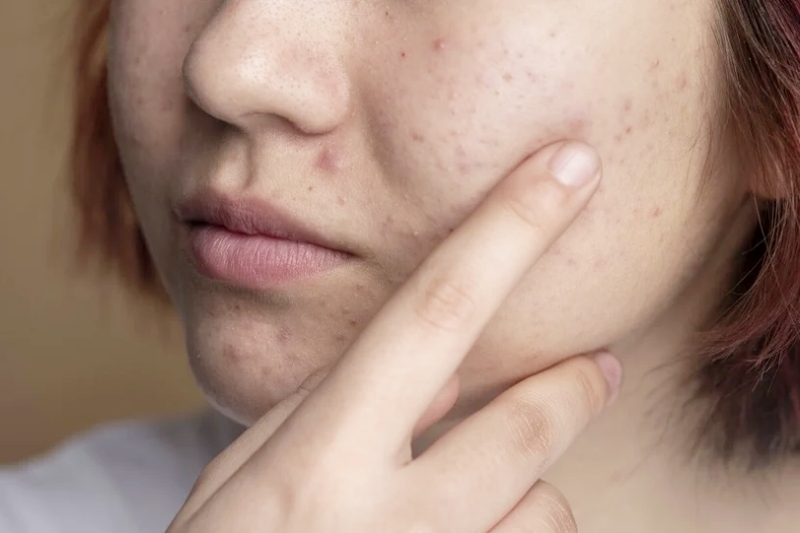 Hướng dẫn dùng Retinol đúng cách, da bị nổi mụn khi dùng có phải là điều bình thường?- Ảnh 2.