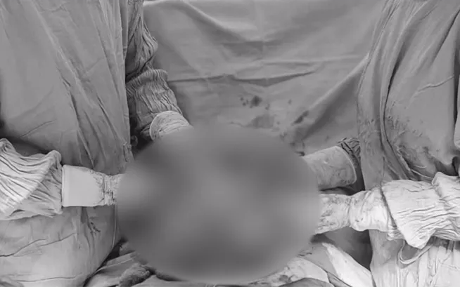 U xơ tử cung khổng lồ 7kg: Ca phẫu thuật căng thẳng kéo dài 6 giờ- Ảnh 1.