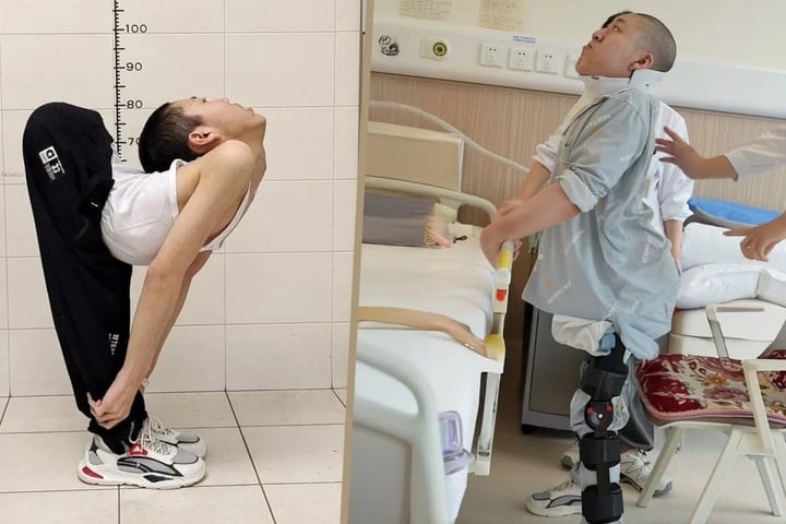 Chàng trai có cột sống gập hình chữ Z lần đầu đứng thẳng sau nhiều ca phẫu thuật- Ảnh 2.