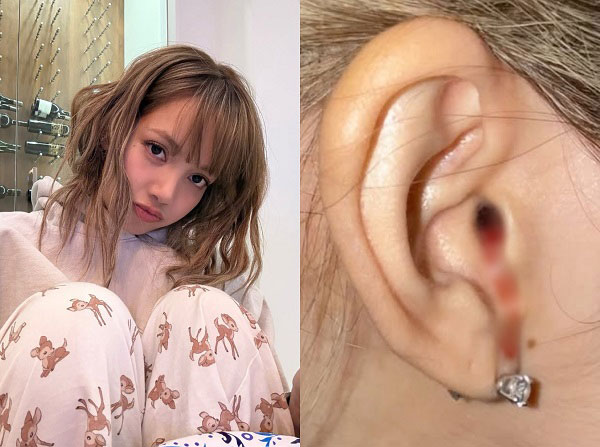 "Máu nhỏ giọt từ tai tôi", tiết lộ của Lisa (BlackPink) khiến nhiều người lo lắng: Chuyên gia chỉ ra nguyên nhân- Ảnh 1.