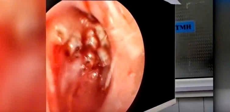 Dòi đóng ổ trong mũi người phụ nữ- Ảnh 1.