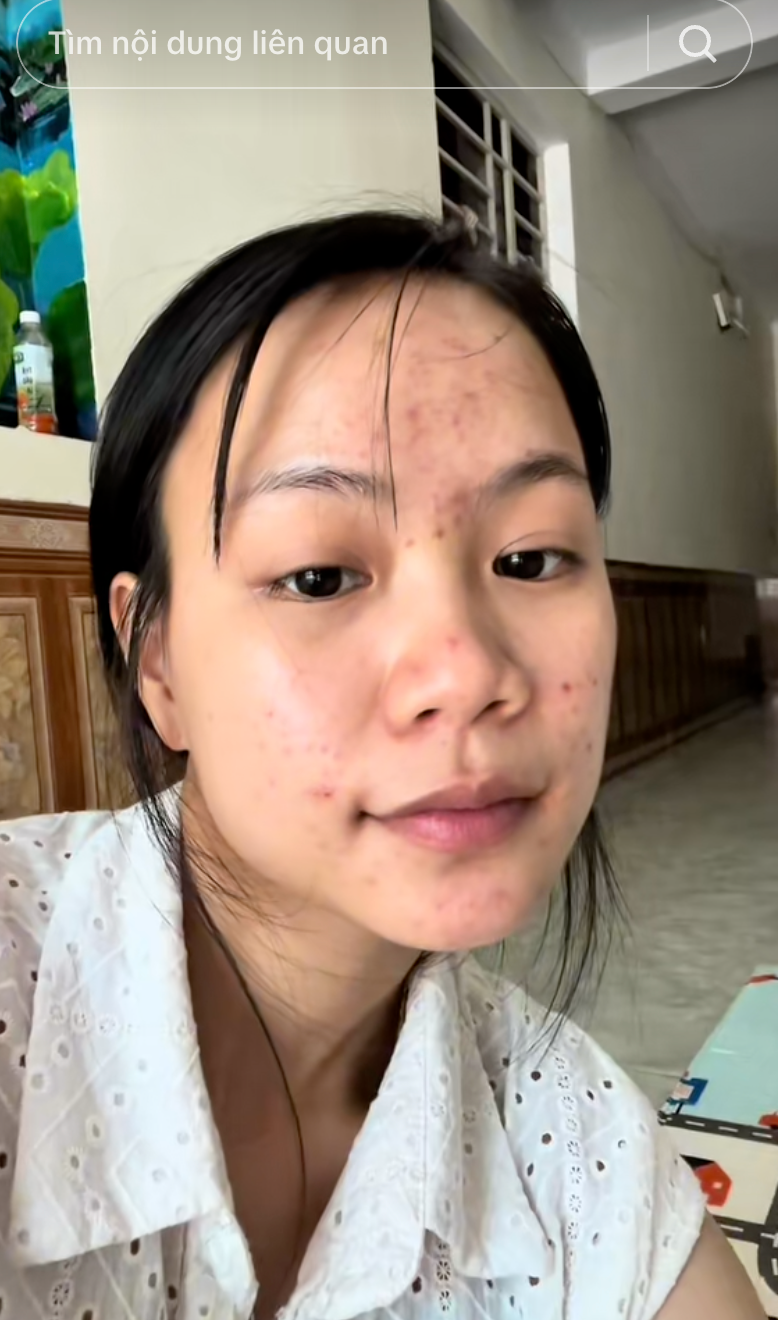 Trị mụn ẩn, thâm mụn trong 1 tuần, cô nàng dùng chiêu đơn giản đến không ngờ- Ảnh 3.