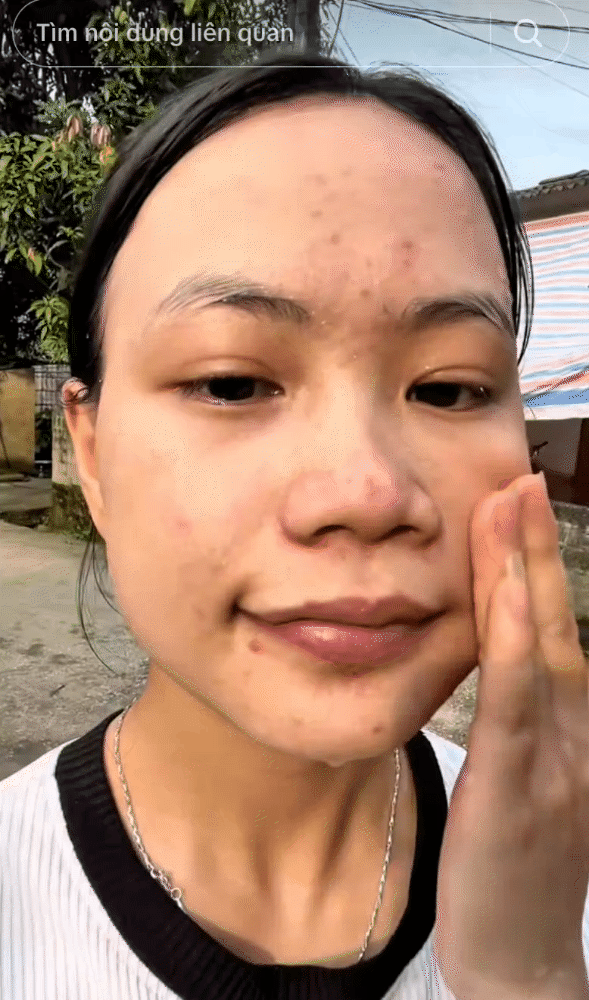 Trị mụn ẩn, thâm mụn trong 1 tuần, cô nàng dùng chiêu đơn giản đến không ngờ- Ảnh 2.