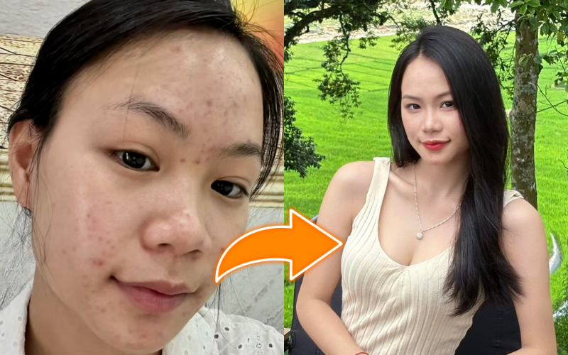 Trị mụn ẩn, thâm mụn trong 1 tuần, cô nàng dùng chiêu đơn giản đến không ngờ- Ảnh 1.