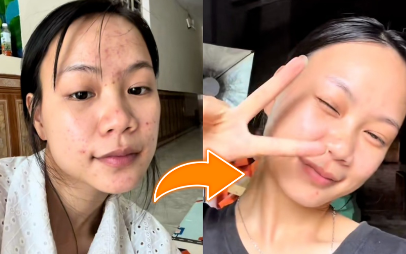 Trị mụn ẩn, thâm mụn trong 1 tuần, cô nàng dùng chiêu đơn giản đến không ngờ- Ảnh 11.
