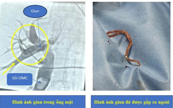 Điều trị bệnh nhân tắc ống mật vì sỏi, bác sĩ phát hiện thêm con giun dài 15cm "quằn quại" bên trong- Ảnh 3.
