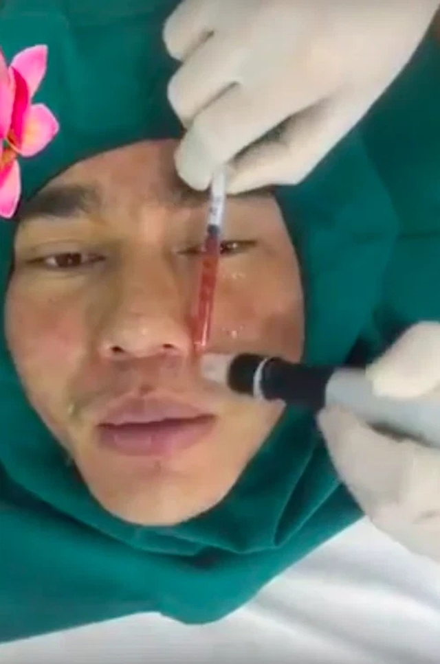 Sao nam Việt nghiện phẫu thuật thẩm mỹ: Từng cứ 10 ngày lại đi chỉnh sửa 1 lần, bị tụt sụn mũi khi đang chạy bộ- Ảnh 4. Sao nam Việt nghiện phẫu thuật thẩm mỹ: Từng cứ 10 ngày lại đi chỉnh sửa 1 lần, bị tụt sụn mũi khi đang chạy bộ- Ảnh 4.