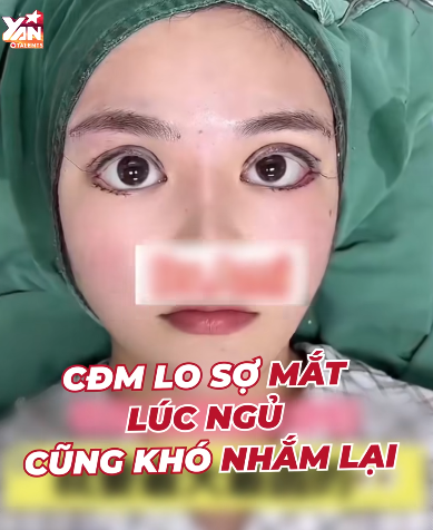 Trào lưu phẫu thuật thẩm mỹ dáng mắt minion ở Trung Quốc gây tranh luận, CĐM chỉ sợ mắt lúc ngủ khó mà nhắm lại được- Ảnh 3.