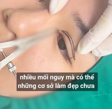 Trào lưu phẫu thuật thẩm mỹ dáng mắt minion ở Trung Quốc gây tranh luận, CĐM chỉ sợ mắt lúc ngủ khó mà nhắm lại được- Ảnh 2.