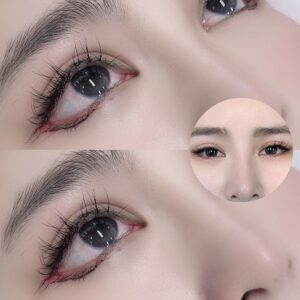 Trào lưu phẫu thuật thẩm mỹ dáng mắt minion ở Trung Quốc gây tranh luận, CĐM chỉ sợ mắt lúc ngủ khó mà nhắm lại được- Ảnh 6.