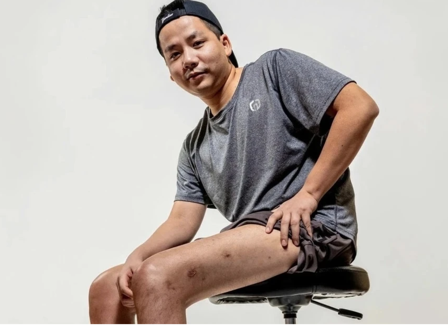 YouTuber "giàu nhất Việt Nam" chi gần 3 tỷ đồng để kéo chân dài thêm 7 cm: Bác sĩ nói gì?- Ảnh 1.