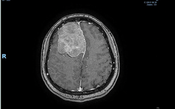 Thường đau đầu nhẹ, một nữ v&otilde; sư ở TP.HCM đi kh&aacute;m th&igrave; sốc với kết quả chụp MRI n&atilde;o