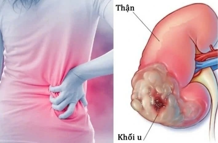 Dấu hiệu âm thầm của ung thư thận dễ bị bỏ qua- Ảnh 1.